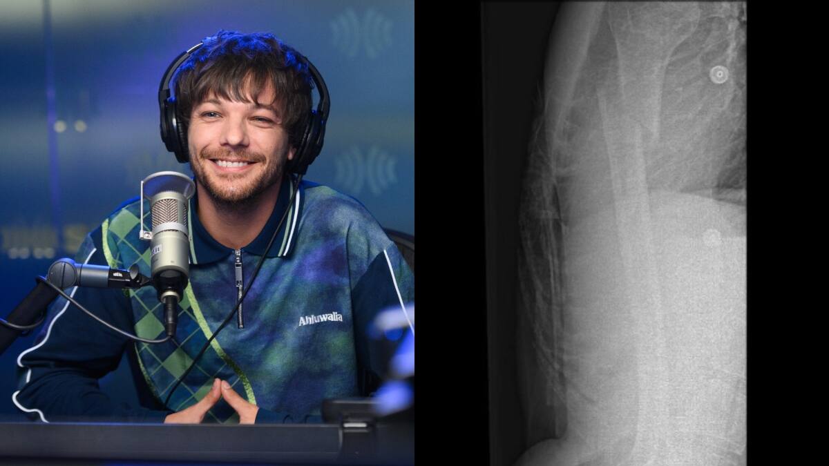 Louis Tomlinson se rompe el brazo y se ve obligado a cancelar las promociones de su álbum