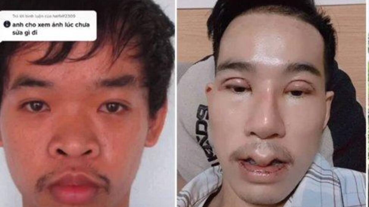 ¿Lo harías? Joven se opera nueve veces el rostro luego de ser rechazado en un trabajo