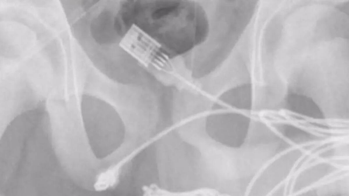 ¿Espera, qué?: Joven de 15 años se metió un USB en el pene y tuvo que ser operado